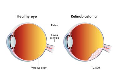 Retinoblastoma 'nın vektör çizimi, anatomi kavramı