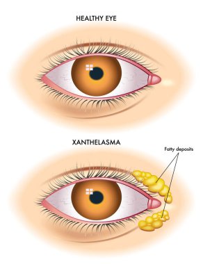 Xanthelasma vektör illüstrasyonu, anatomi kavramı