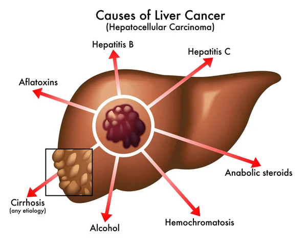 Ilustração Vetorial Das Causas Câncer Fígado Conceito Anatomia —  Vetores de Stock