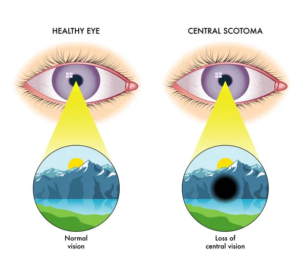 Ilustração Vetorial Escotoma Central Conceito Anatomia — Vetor de Stock