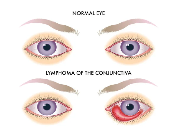 Vector Illustratie Van Lymfoom Van Het Conjunctiva Anatomie Concept — Stockvector