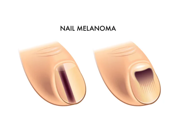 Vector Illustration Nail Melanoma Anatomy Concept — Stock Vector