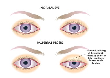 Tıbbi illüstrasyon, palpebral ptosdan etkilenen normal gözle göz arasında bir karşılaştırma gösteriyor..