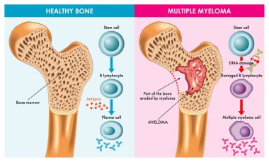 medical illustration showing the difference between healthy bone and decomposable multiple myeloma caused by DNA damage. clipart