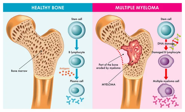 Ilustrasi Medis Menunjukkan Perbedaan Antara Tulang Sehat Dan Myeloma Berganda - Stok Vektor