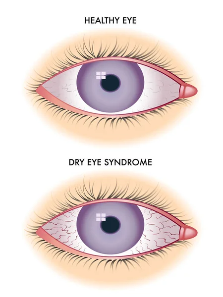 Medical Illustration Shows Comparison Ordinary Eye Person Suffering Distichiasis — Stock Vector