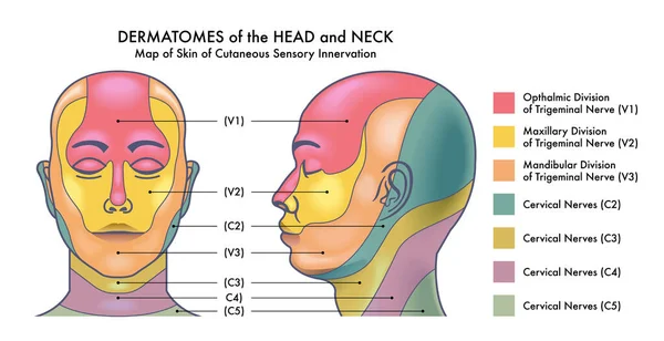 Medicinsk Illustration Huvud Och Hals Dermatit — Stock vektor
