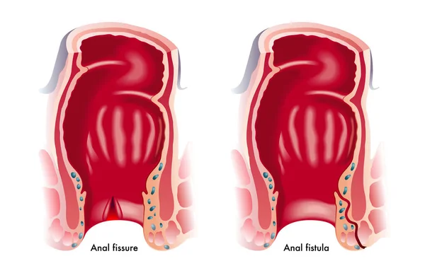 Illustration Médicale Montrant Deux Troubles Anaux Communs Fissure Anale Fistule — Image vectorielle