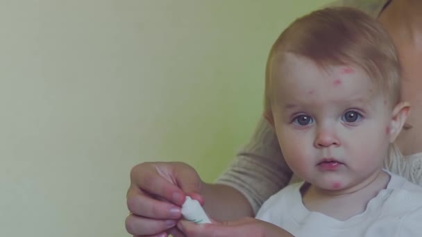 Moms defocused hand applies antiallergic cream to the face of a toddler with skin rashes and allergies to red spots caused by a mosquito bite. Copy space - itching concept, dermatology, rash treatmen — Stockvideo