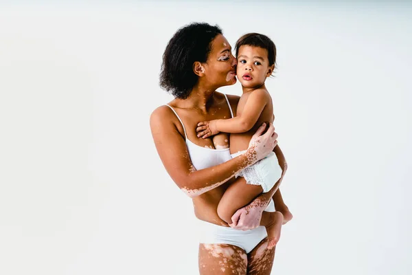 Happy Black Woman Vitiligo Holding Her Baby Colored Background Young — Stock Photo, Image