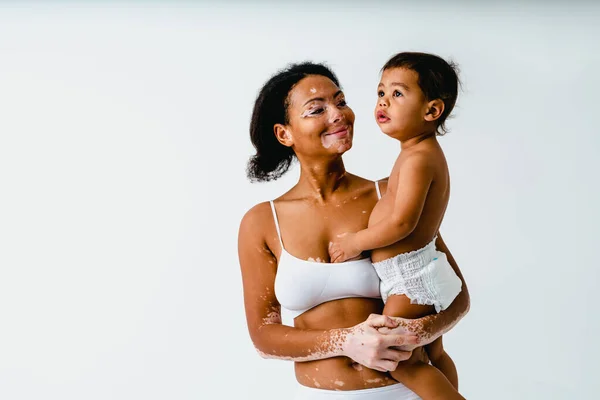 Happy Black Woman Vitiligo Holding Her Baby Colored Background Młoda — Zdjęcie stockowe