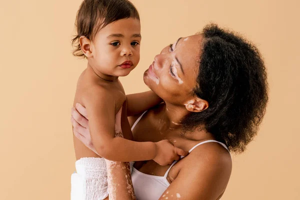 Heureuse Femme Noire Avec Vitiligo Tenant Son Bébé Sur Fond — Photo