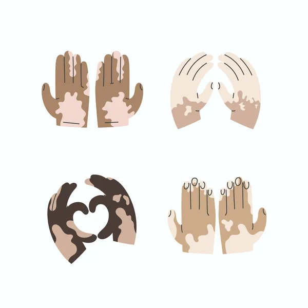 Ensemble d'icônes de la main avec vitiligo dans divers gestes — Image vectorielle