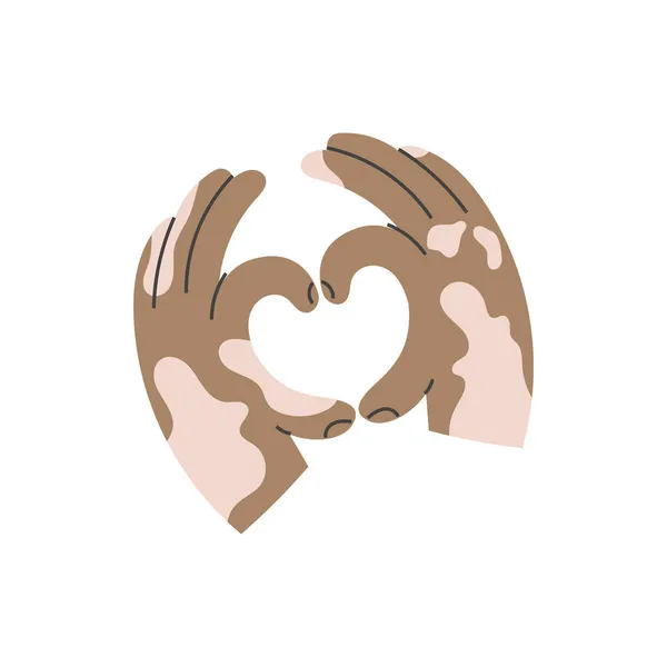 Swarliwe dłonie z bielmo zrobić gest kształt serca — Wektor stockowy