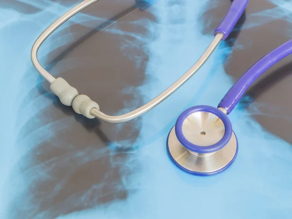 Stethoscope on blue x-ray film — Stock Photo, Image