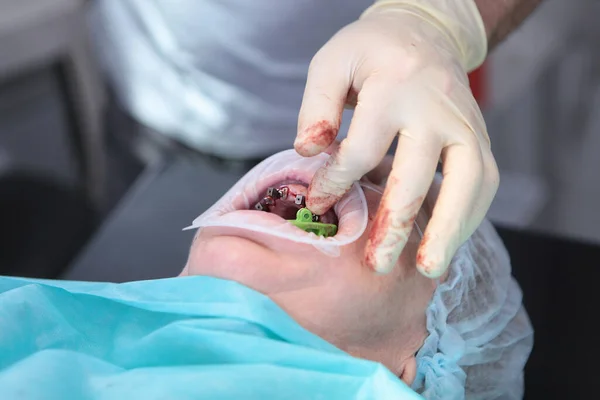 Operacja Instalacji Wielu Implantów Klinice Stomatologicznej Operacja Znieczuleniu Ogólnym Staruszku — Zdjęcie stockowe