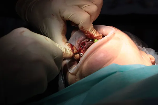 Estrazione dei denti prima dell'installazione degli impianti dentali.Bocca aperta. Odontoiatria moderna. Persona irriconoscibile. — Foto Stock