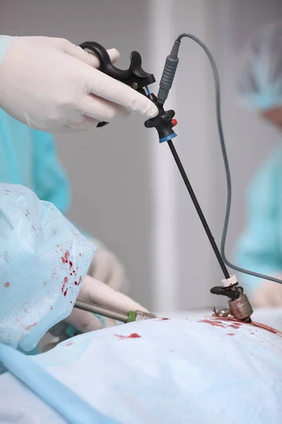 Cirurgia Laparoscópica Operação Sob Anestesia Geral Fotografia Vertical Cirurgia Moderna — Fotografia de Stock