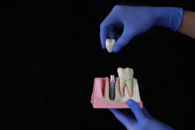 Diş implantı konsepti. Mizanpaj üzerinde görsel gösteri. Diş implantı. Diş hekimliği ve diş bakımı kavramı. Dişçide muayene. Siyah arkaplan. Kopya alanı da var..
