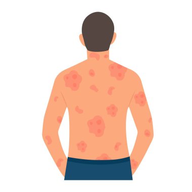 Dermatolojik deri hastalığı, sedef hastalığı. Alerjik kaşıntı, deri iltihabı, kızarıklık ve tahriş. Sedef hastalığını temizle..