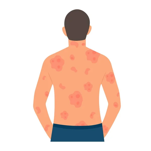Dermatologisk Hudsjukdom Psoriasis Allergisk Klåda Hudinflammation Rodnad Och Irritation Guttate — Stock vektor