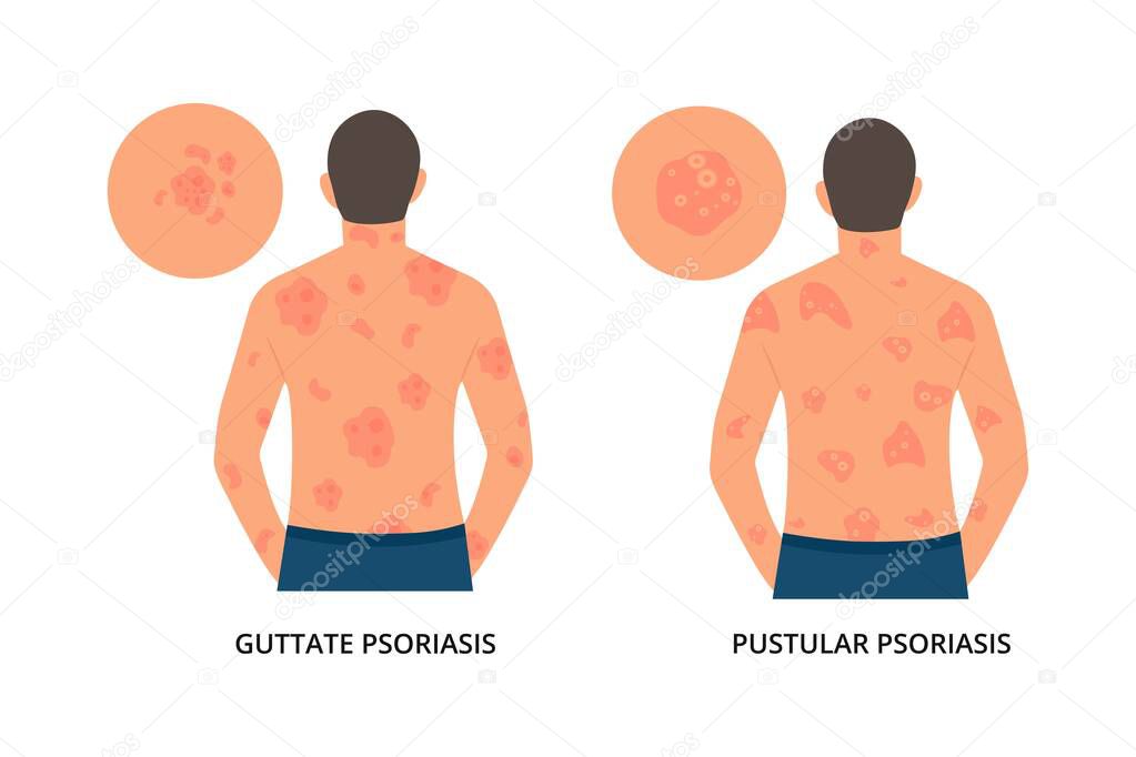 Man has allergic itching, skin inflammation, redness and irritation.Guttate,postular psoriasis.Atopic dermatitis, eczema, psoriasis, dry skin. Skin problems.isolated, vector.