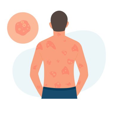 The man has alergic itching, skin inflammation, redness and irritation. Pustular psoriasis.Atopic dermatitis, eczema, psoriasis, dry skin. Skin problems Concept, isolated, vector.