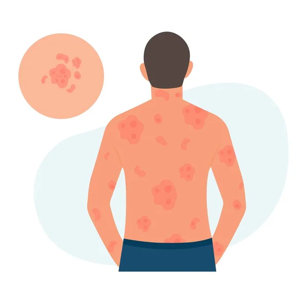 Man Has Alergic Itching Skin Inflammation Redness Irritation Guttate Psoriasis — Stockvektor