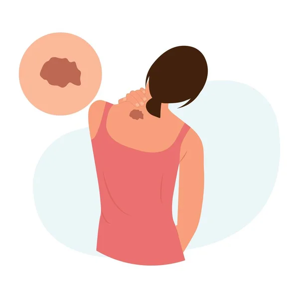 Donna Con Macchia Pigmento Marrone Scuro Sulla Pelle Melanoma Dermatologia — Vettoriale Stock