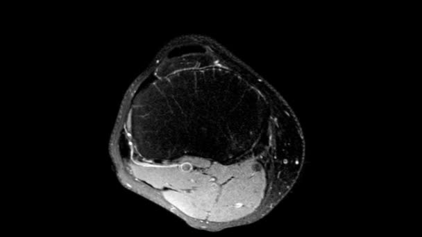 MRI knee joint. Dynamics of scrolling through MRI images. Magnetic resonance imaging of right knee - view from above. Diagnosis sport trauma and damage of ligaments. — ストック動画