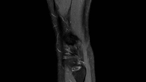 Dynamisches Scrollen durch MRT-Bilder des Kniegelenks. Diagnose Sporttrauma und Bänderverletzung. Kernspintomographie des rechten Knies. — Stockvideo