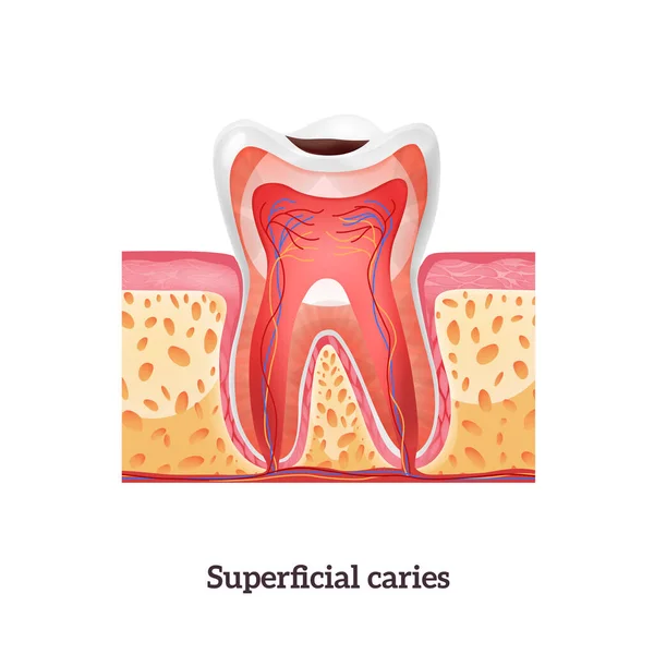 Zubní anatomie Caries — Stockový vektor