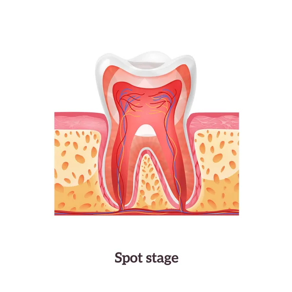 Caries realista Anatomía dental — Vector de stock