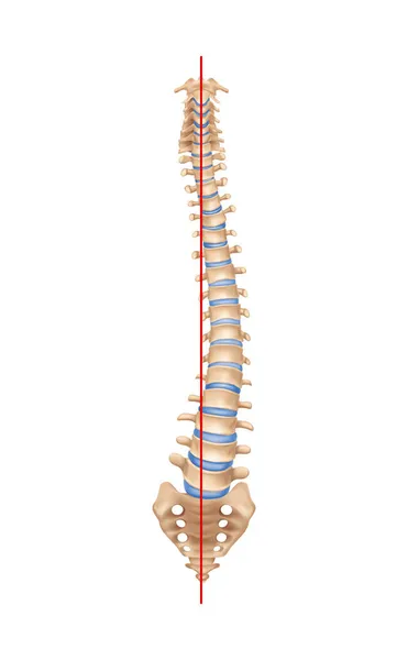 Realistic Scoliosis Spine Composition — Stock Vector