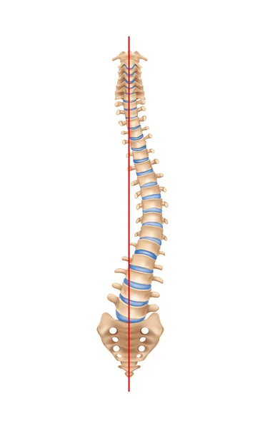 Composição realista da escoliose da coluna vertebral —  Vetores de Stock