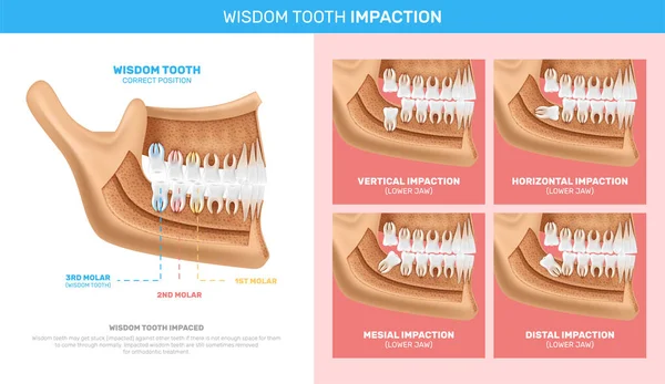 Wisdom Tooth Impaction Infographics — Stock Vector