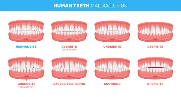 Malocclusion Of Teeth Infographics — Stock Vector