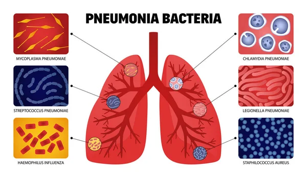 感染性細菌ベクターイラストのサンプルと肺の解剖学的形状の単離された画像を持つヒト肺炎菌セット — ストックベクタ