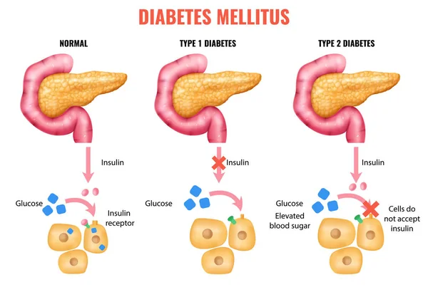 Anatomi Pankreas Yang Realistis Diabetes Mellitus Infografis Dengan Pankreas Yang - Stok Vektor