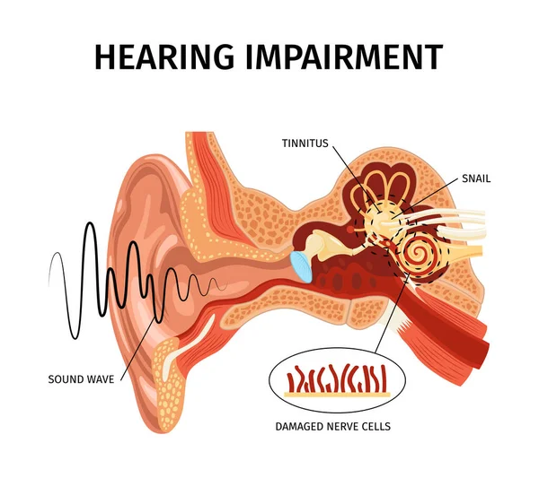 해부학적 Ear Tinnitus 장기의 포인터 텍스트 일러스트 — 스톡 벡터