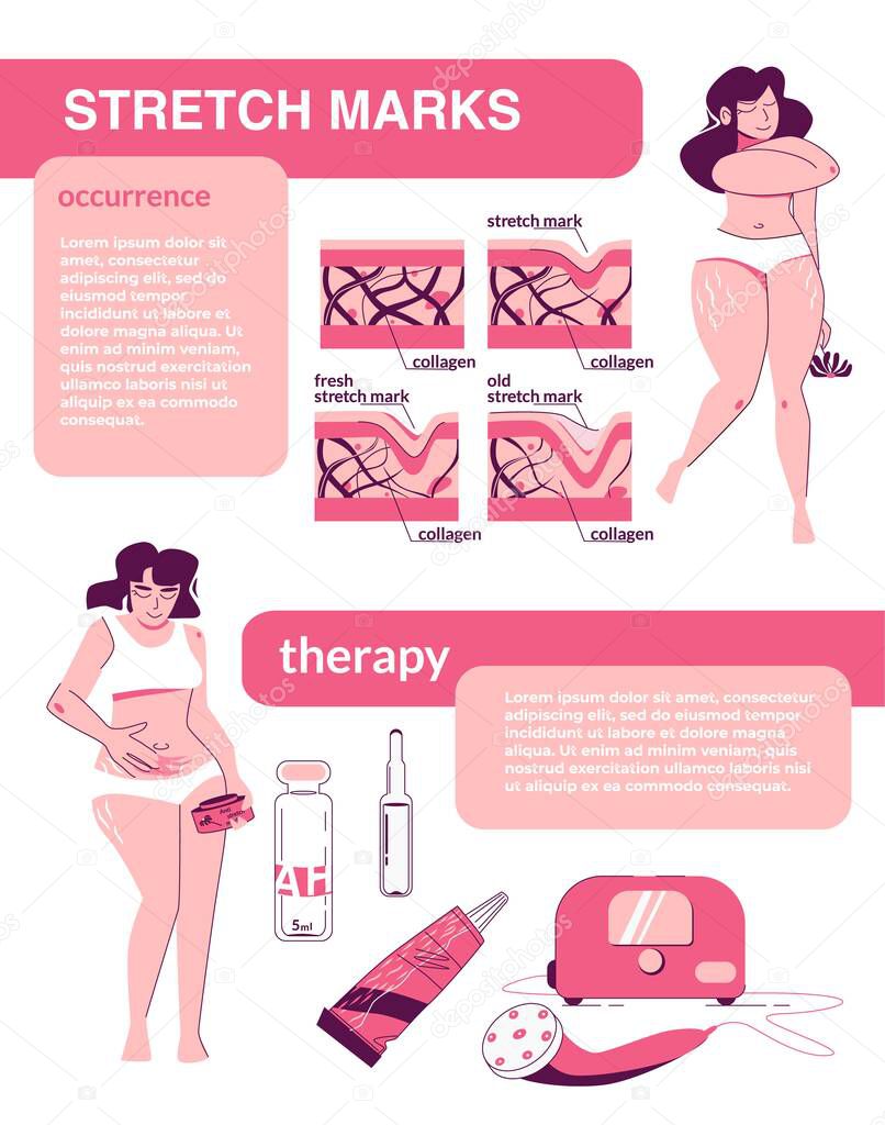 Stretch marks flat infographic composition with editable text and female characters with skin structure cosmetic products vector illustration