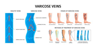 Varicose veins realistic infographics vector illustration with stages of illness scheme of damaged and healthy valves and methods of treatment