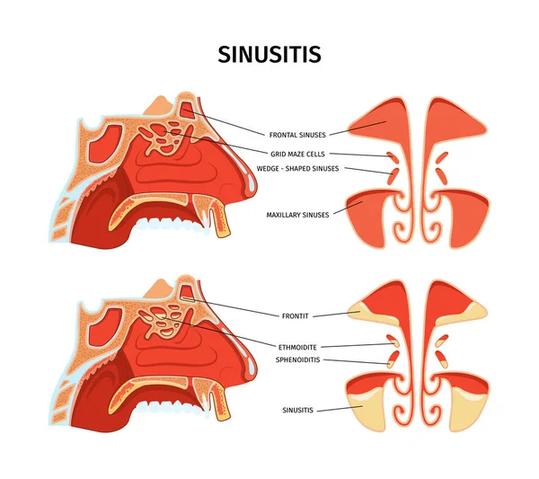 Sinusitis Infographics Cross Section Poster Depicting Inflammation Paranasal Sinuses Including —  Vetores de Stock