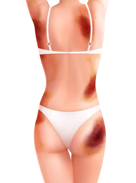 Mujer Lesionada Composición Realista Con Vista Del Cuerpo Femenino Lencería — Vector de stock