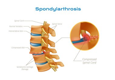 Düzenlenebilir metin göstergeleriyle omurilik anatomisi bilgi grafikleri ve sıkıştırılmış omurilik sinir vektörü illüstrasyonunun daire görünümü