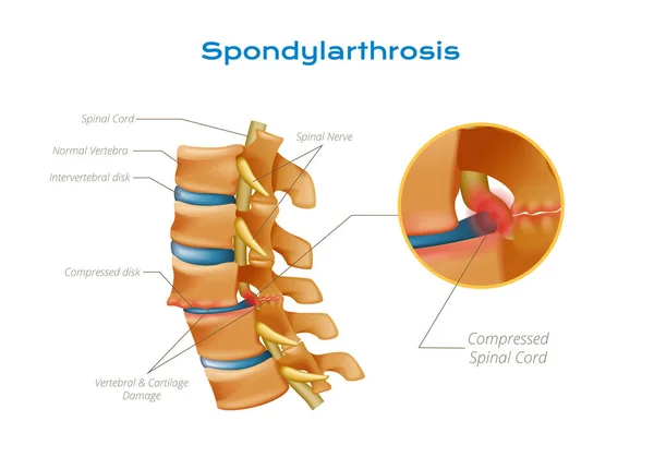 Vertebrae Ryggmärg Anatomi Infographics Med Redigerbara Textpekare Och Cirkelvy Komprimerad — Stock vektor