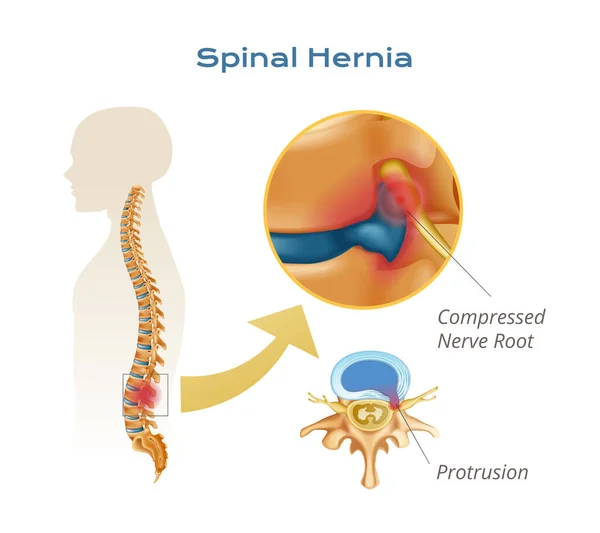 Vertebrae Spinal Cord Anatomy Infographics Body Silhouette Spine Compressed Nerve — Stock Vector