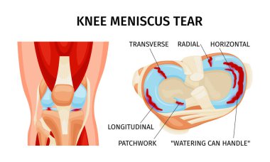 Knee meniscus tear anatomy diagram realistic infographics on white background vector illustration clipart