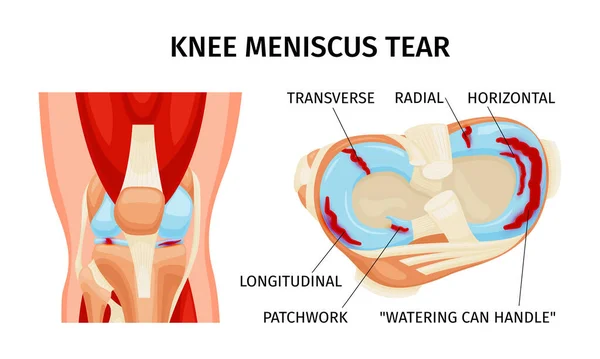 Infografías Realistas Del Diagrama Anatomía Del Desgarro Del Menisco Rodilla — Vector de stock