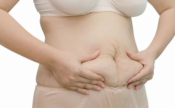 Asian woman showing her stretch marks — Stock Photo, Image